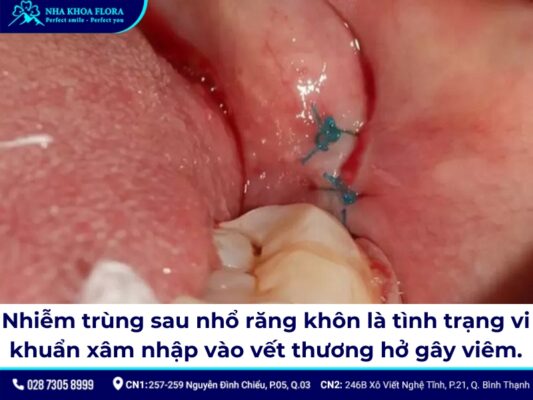 nhiễm trùng sau khi nhổ răng khôn - ảnh 1