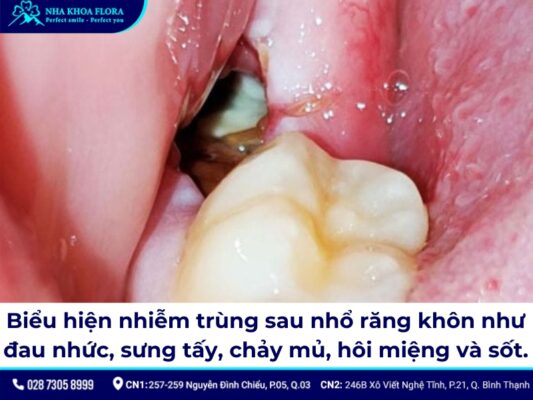 nhiễm trùng sau khi nhổ răng khôn - ảnh 2