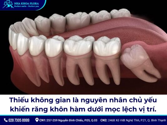 nhổ răng khôn hàm dưới mọc lệch - ảnh 1