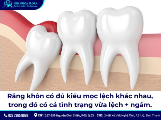 nhổ răng khôn hàm dưới mọc lệch - ảnh 2