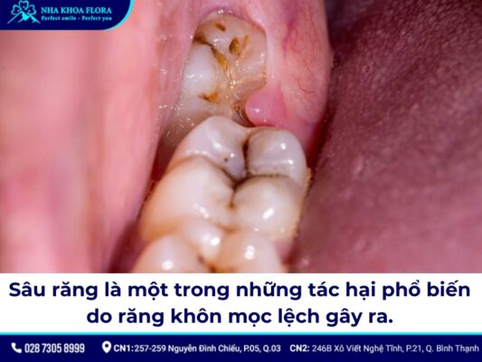 nhổ răng khôn hàm dưới mọc lệch - ảnh 3