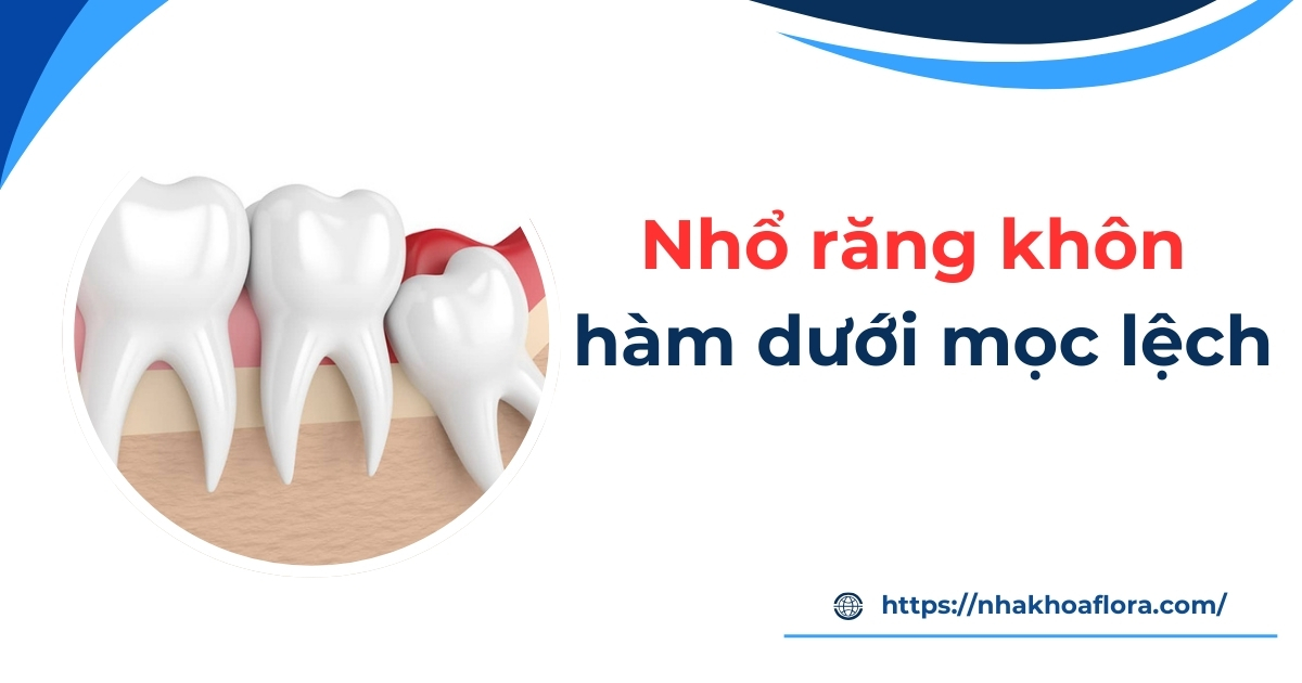 Nhổ răng khôn hàm dưới mọc lệch có nên không? Cần lưu ý gì?