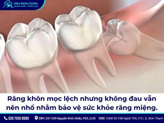 răng khôn mọc lệch nhưng không đau có nên nhổ - ảnh 1