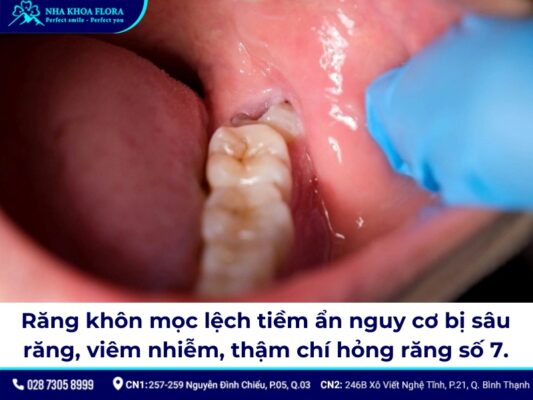 răng khôn mọc lệch nhưng không đau có nên nhổ - ảnh 2