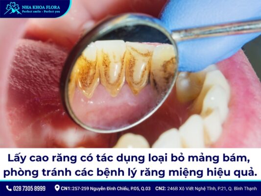 bao lâu cạo vôi răng - ảnh 2