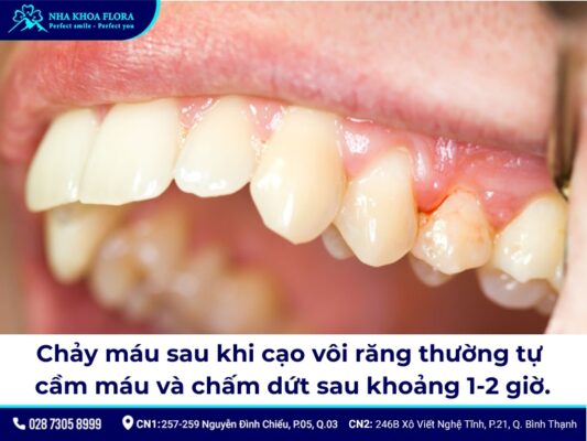 cạo vôi răng chảy máu - ảnh 3 cạo vôi răng chảy máu - ảnh 3