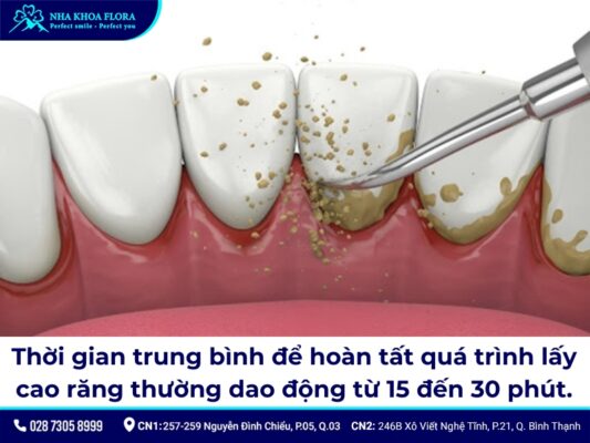 lấy cao răng mất bao lâu - ảnh 1
