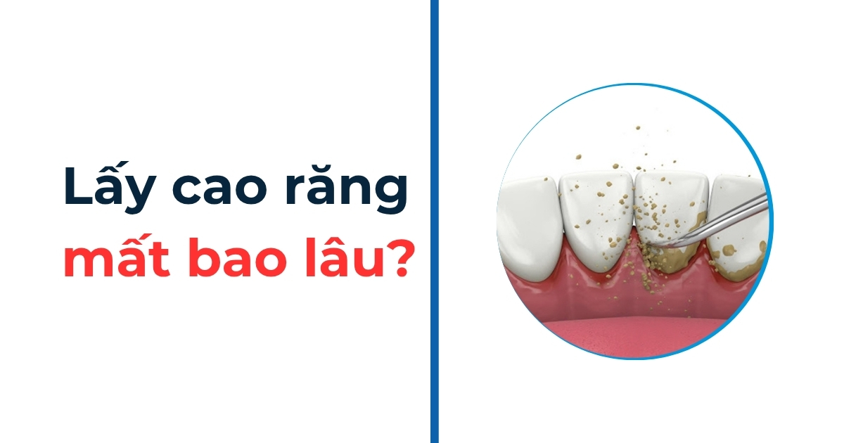 [Hỏi đáp]: Lấy cao răng mất bao lâu thời gian thì xong? 12