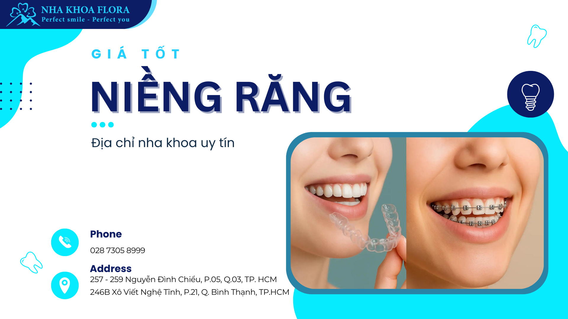 niềng răng