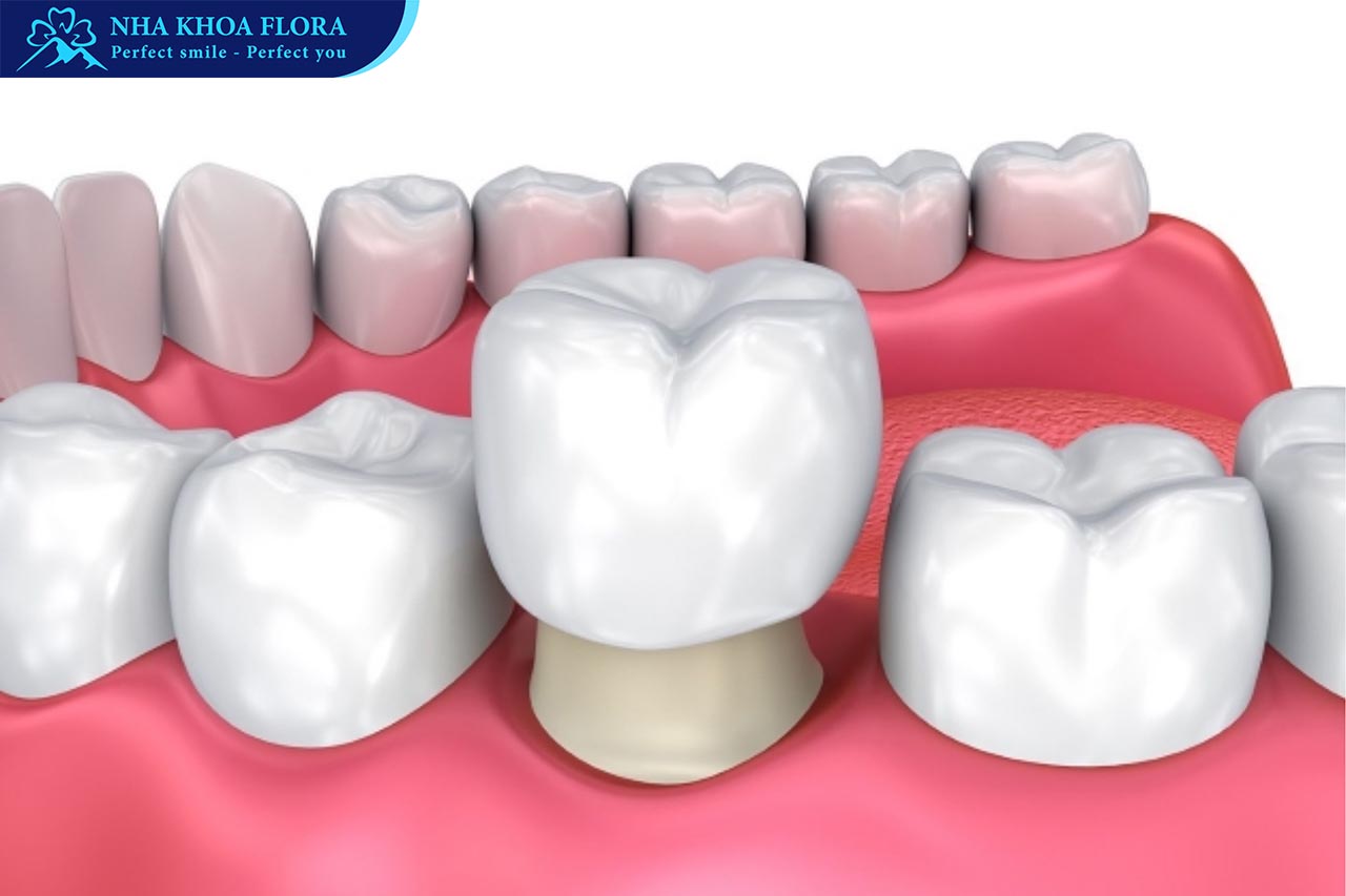 Bọc răng sứ