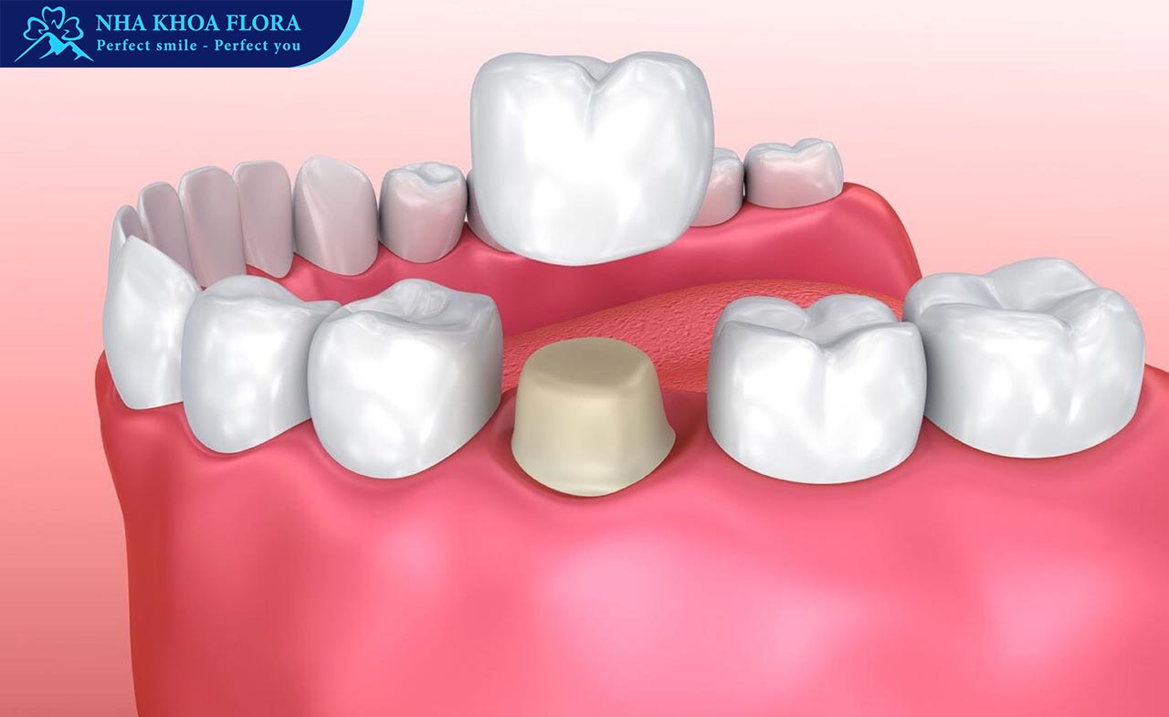 Bọc răng sứ