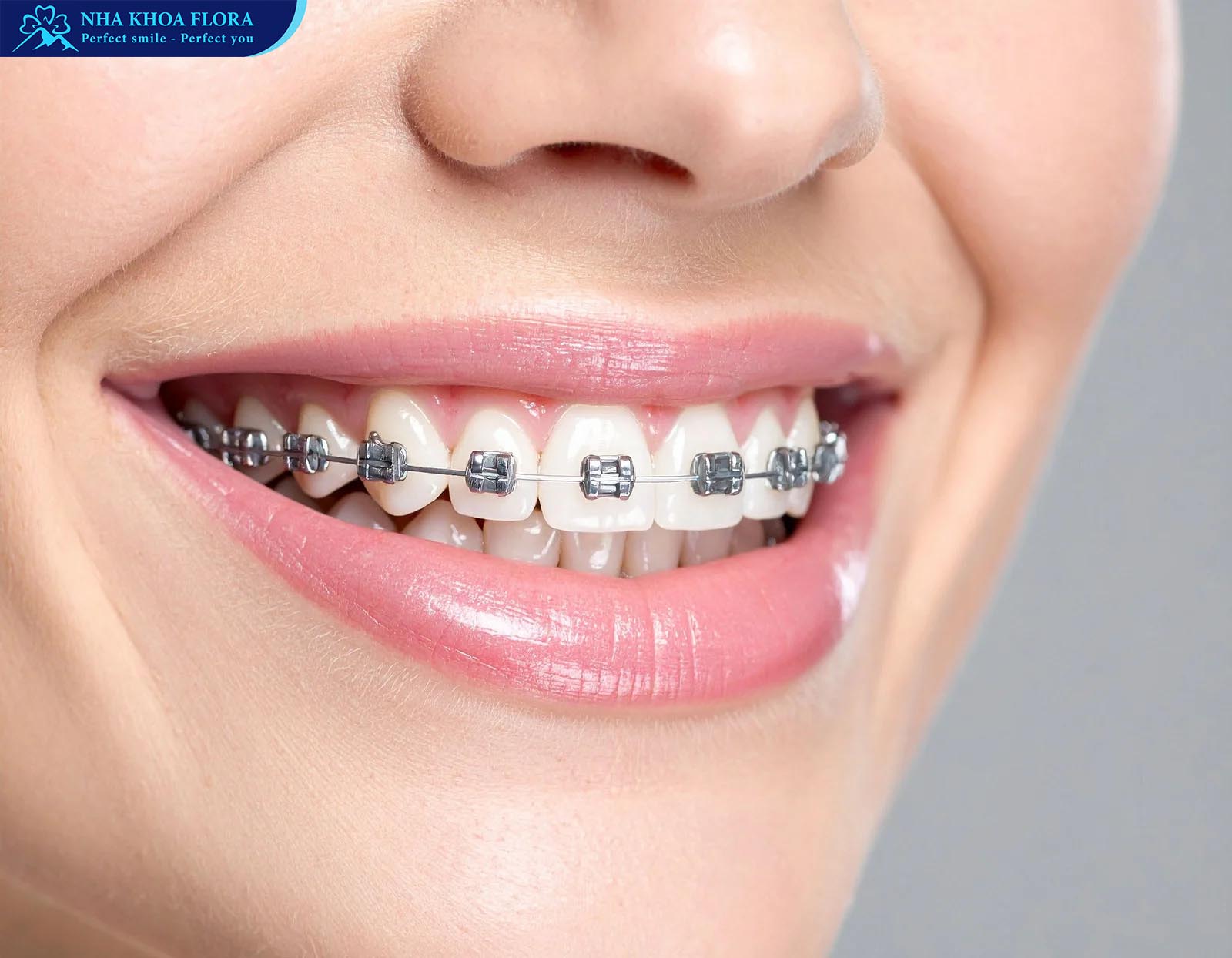 niềng răng mắc cài