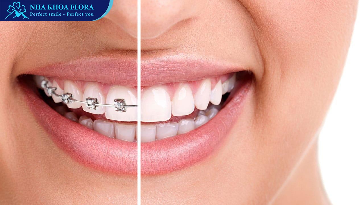 niềng răng mắc cài