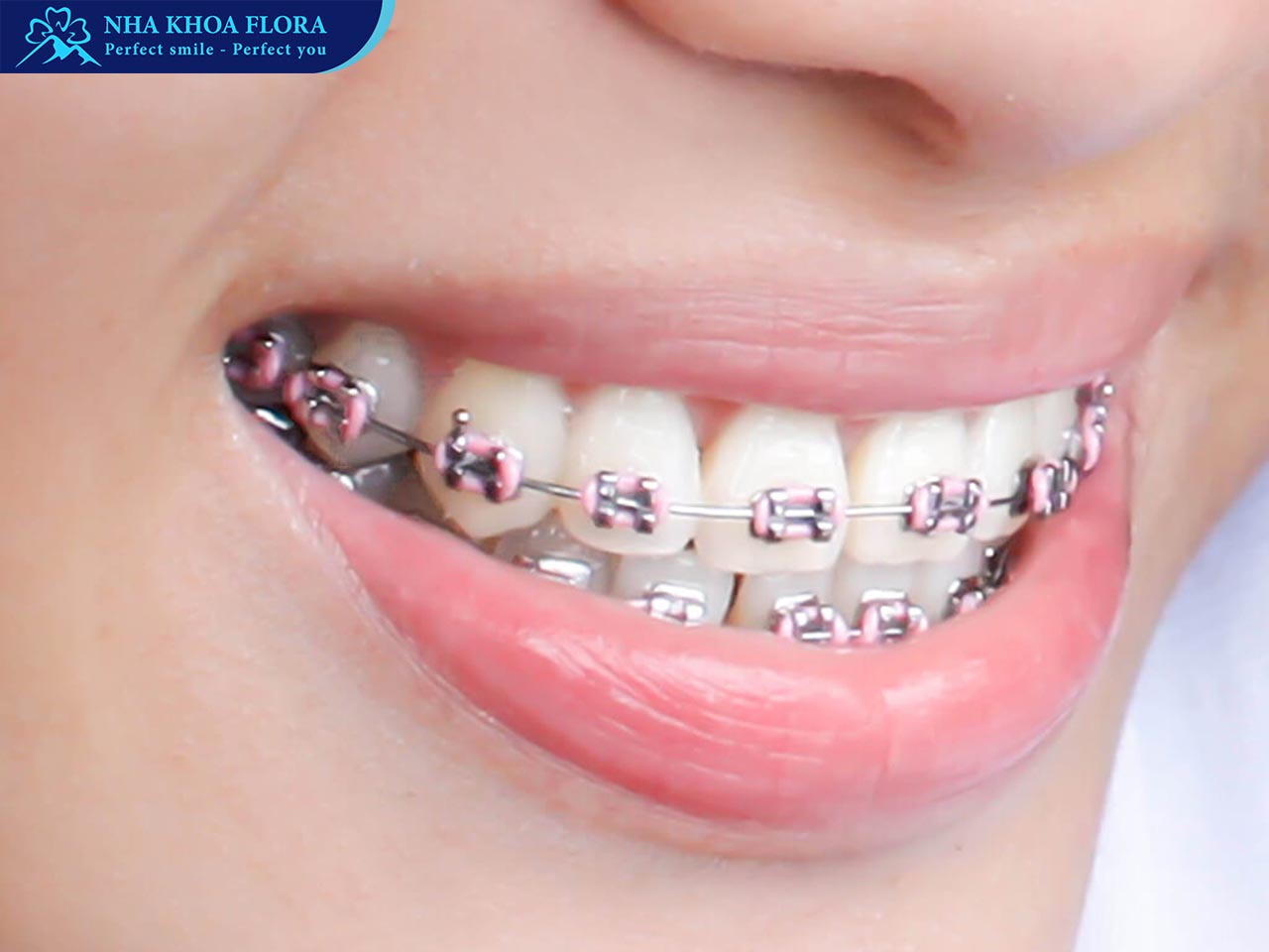 niềng răng mắc cài