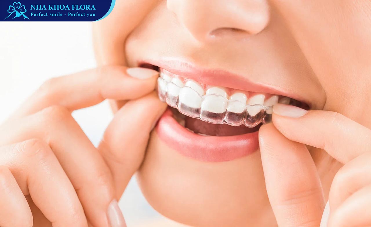 niềng răng trong suốt