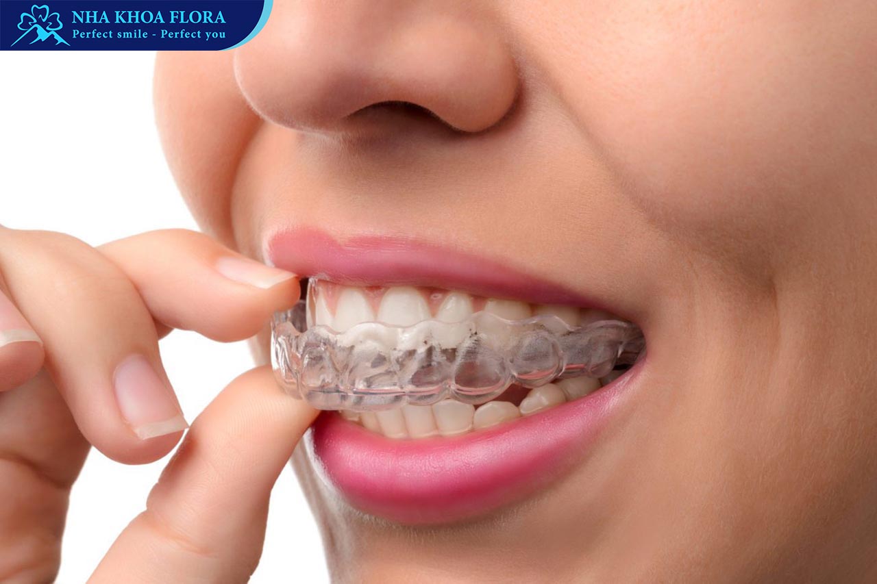 niềng răng trong suốt