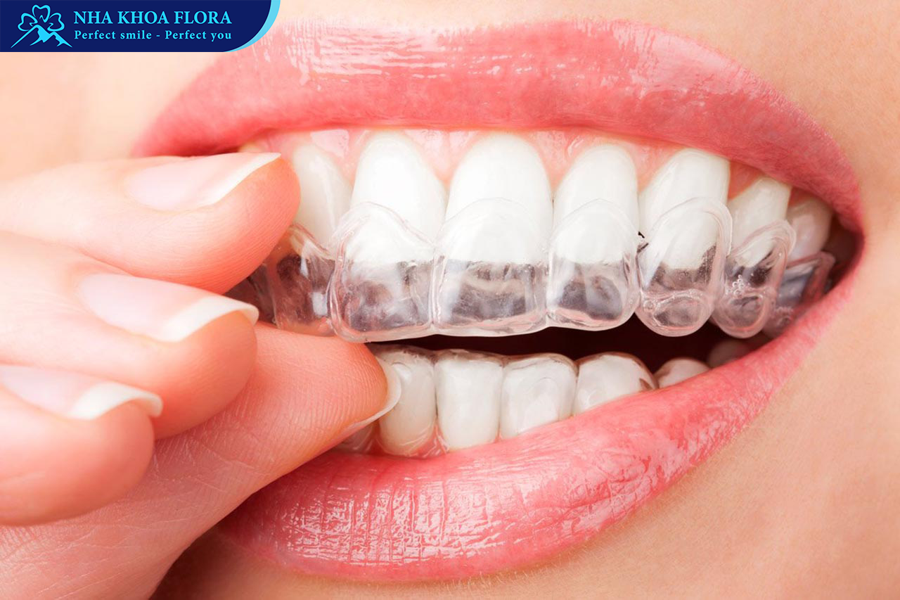 niềng răng trong suốt