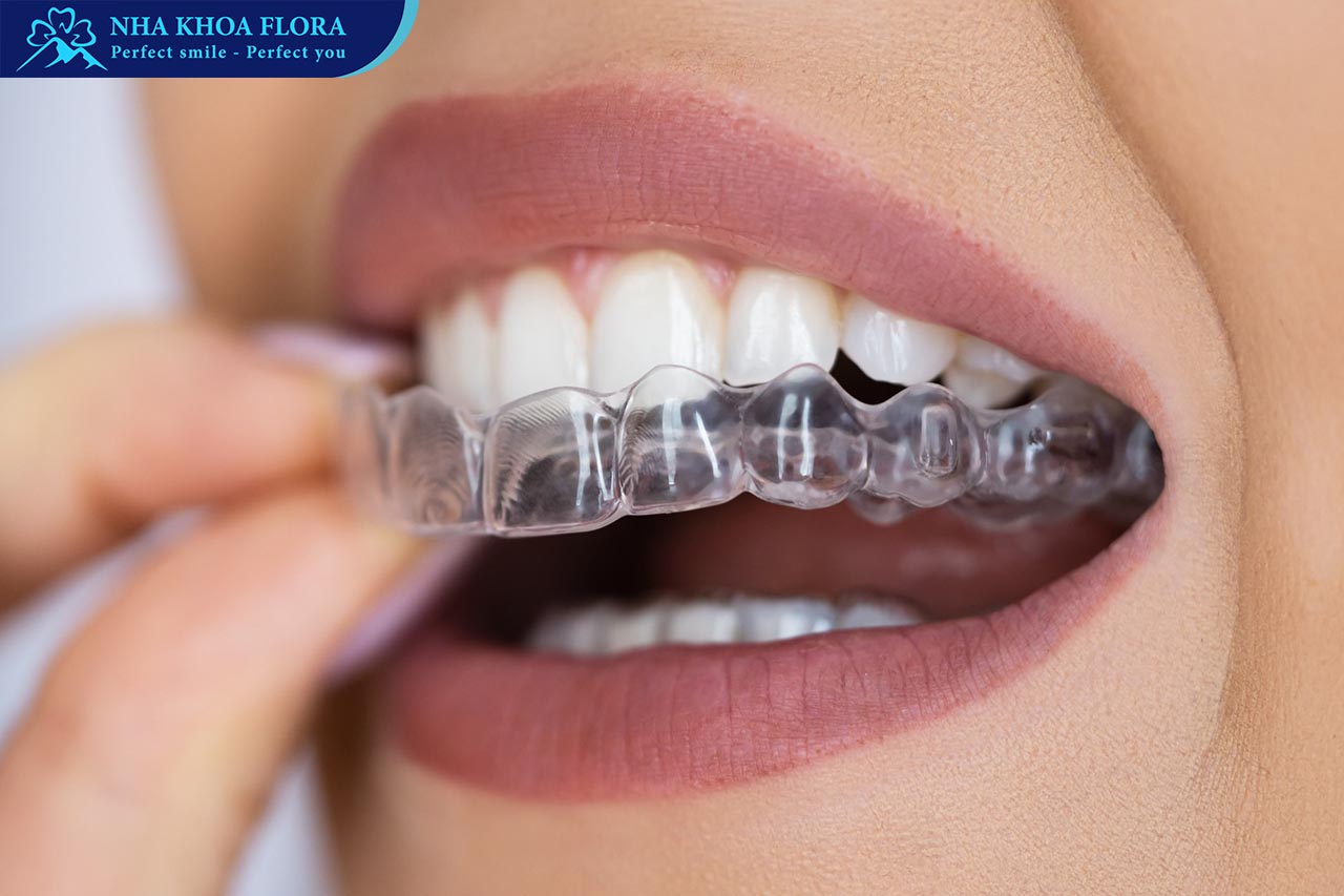 niềng răng trong suốt