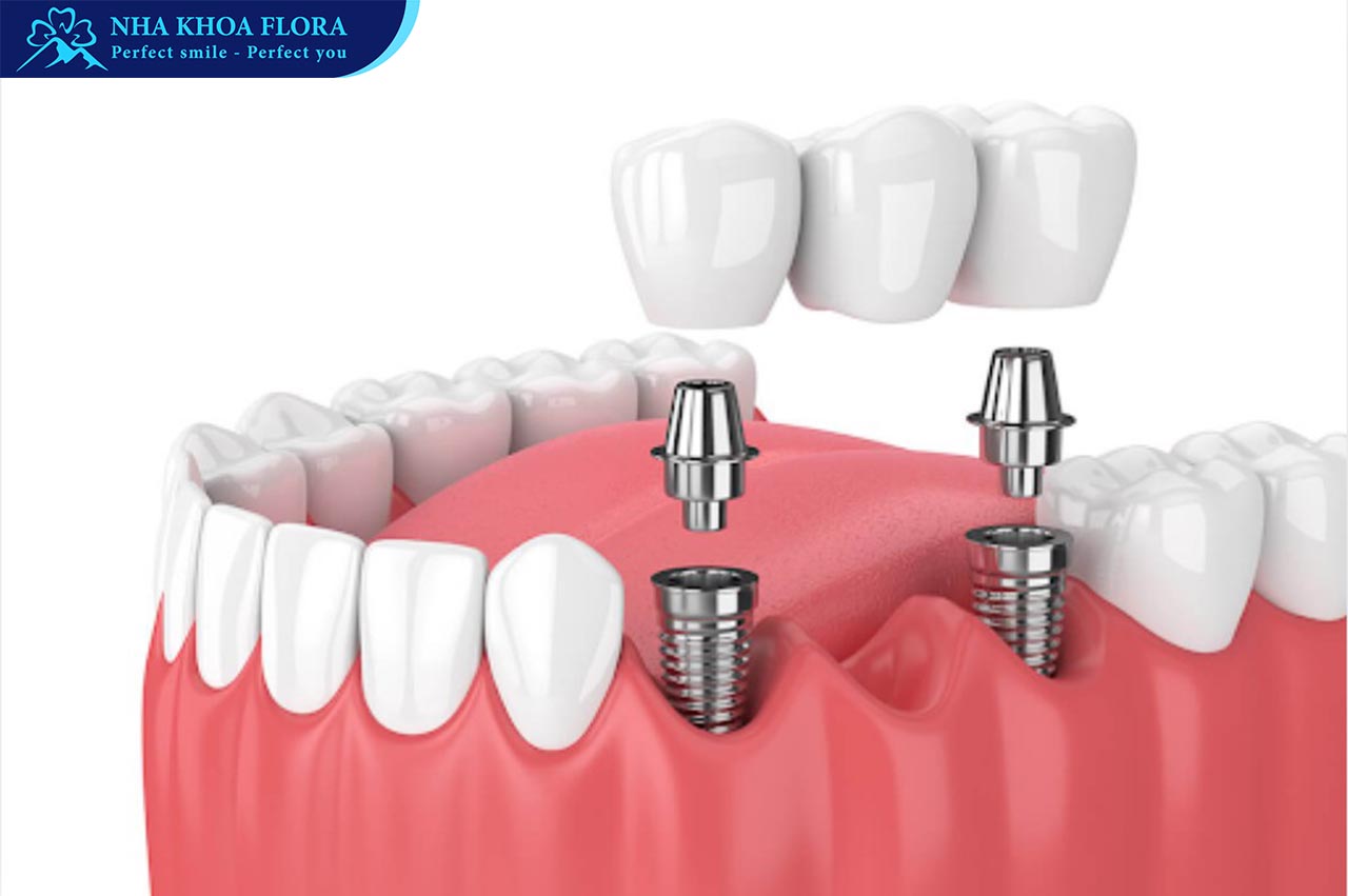 trồng răng Implant