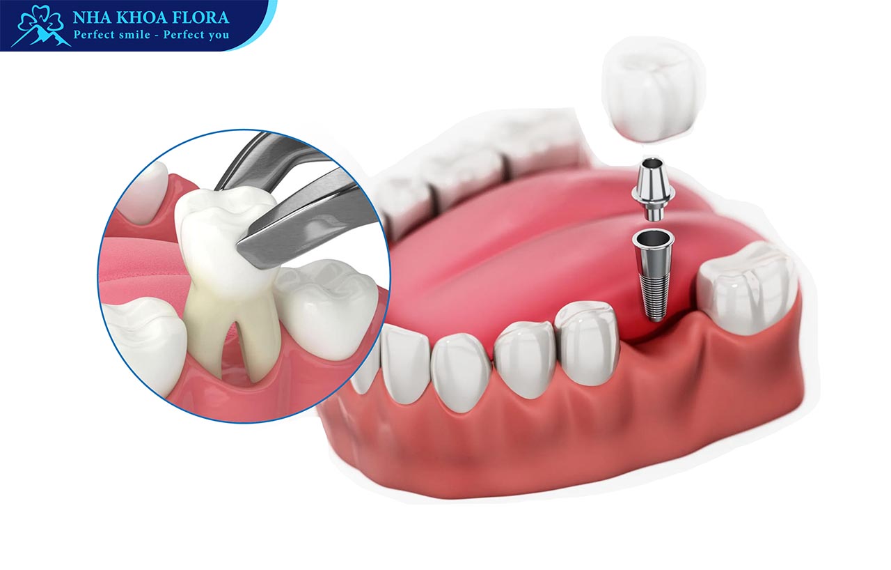 trồng răng Implant