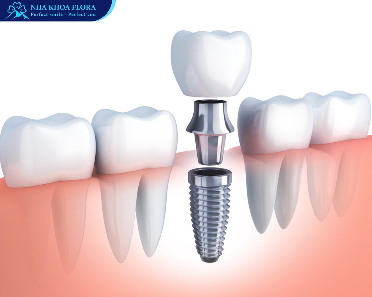 trồng răng Implant