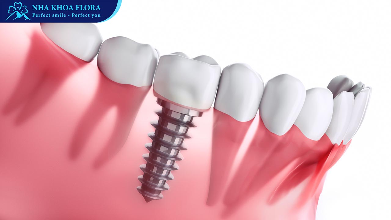 trồng răng Implant