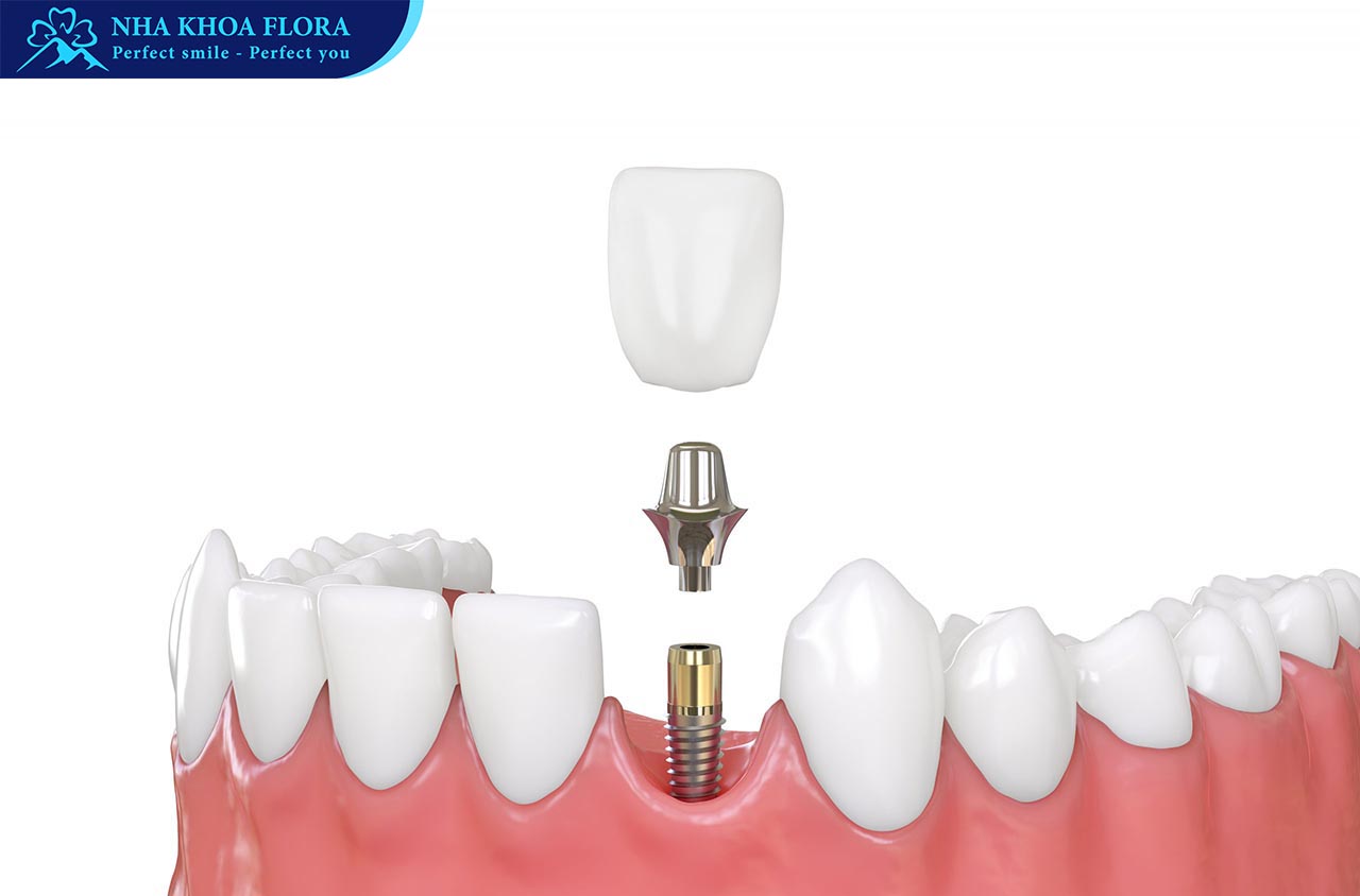 trồng răng Implant