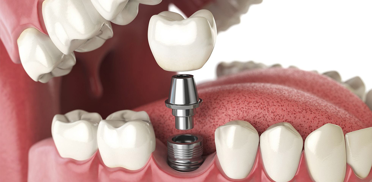 nha khoa cấy ghép Implant