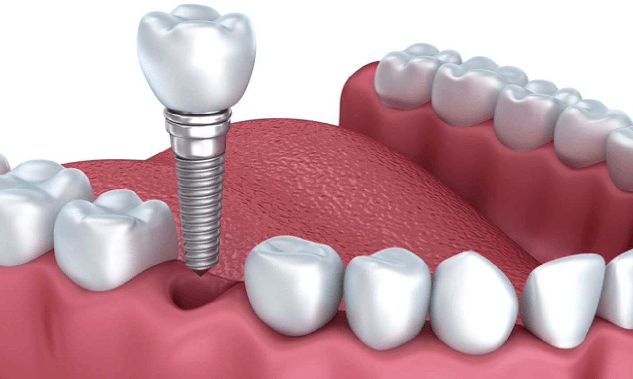 nha khoa cấy ghép Implant