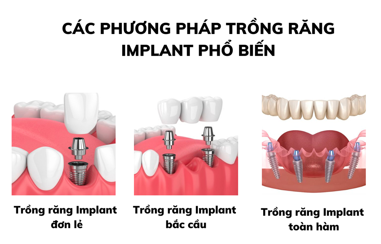 Trồng răng Implant