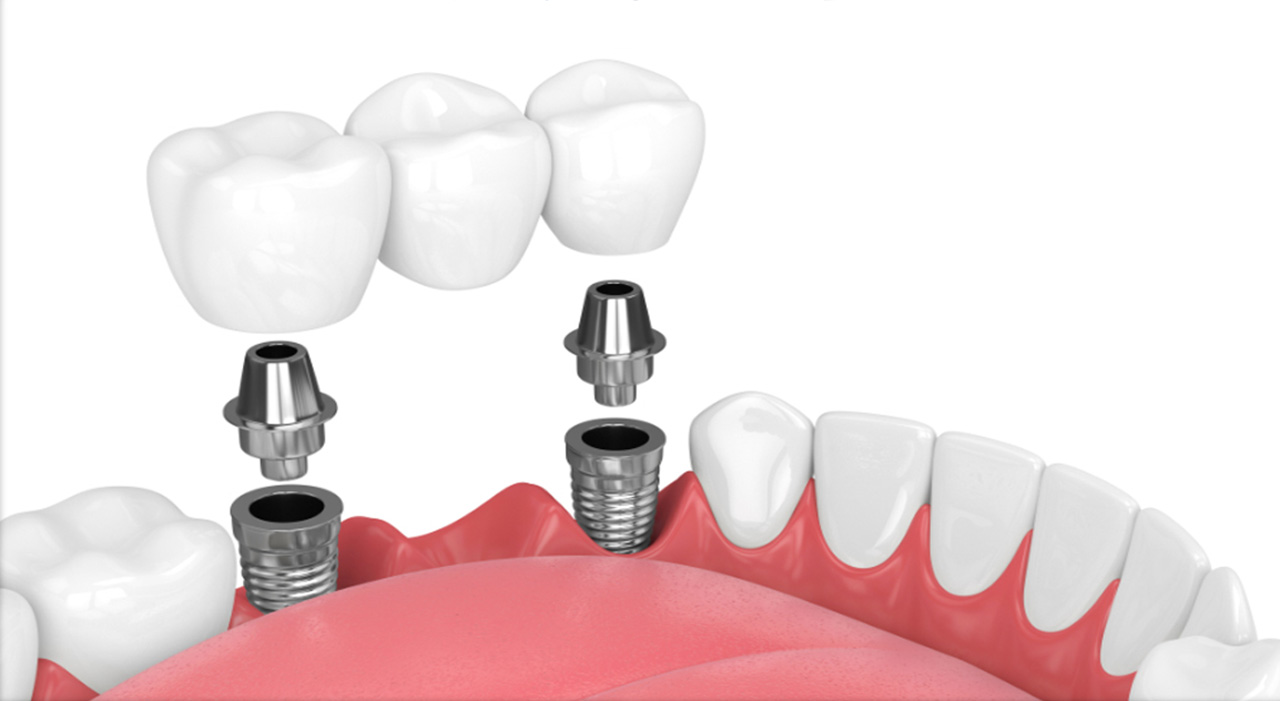 Trồng răng Implant