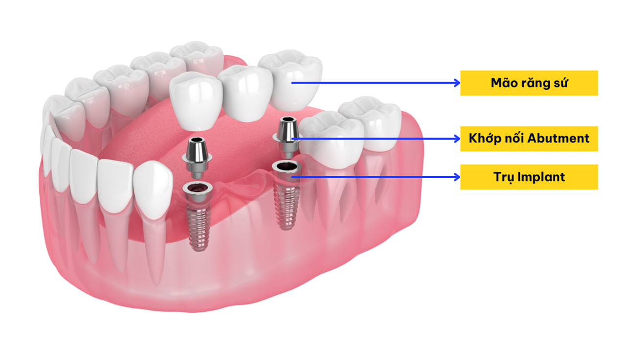 Bảng giá chi phí trồng răng implant Quận 3
