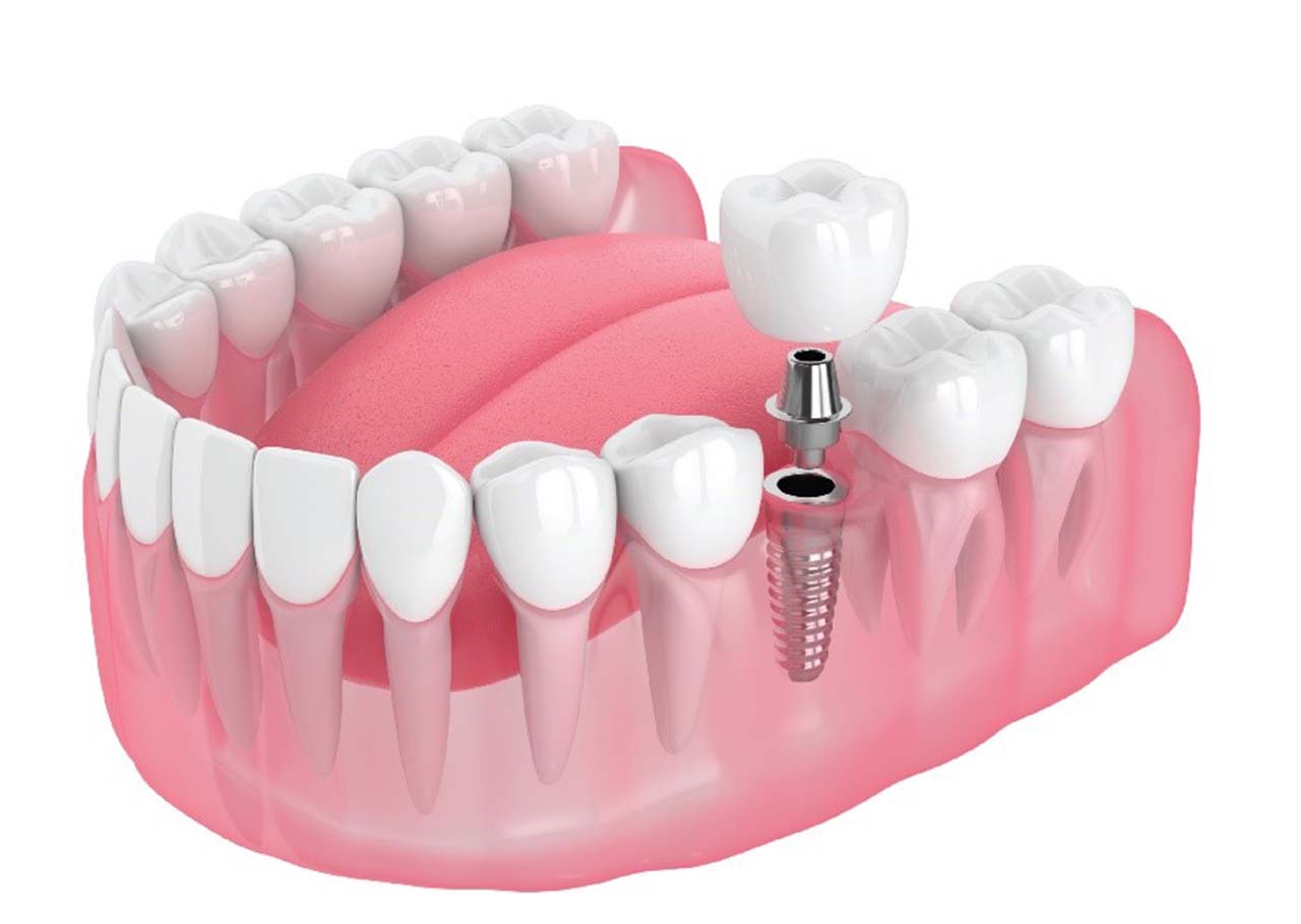 Địa chỉ nha khoa cấy ghép implant uy tín Quận 3