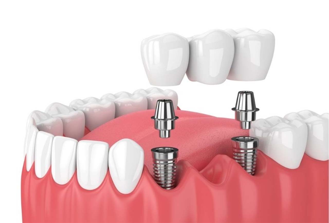 Địa chỉ nha khoa cấy ghép implant uy tín Quận 3
