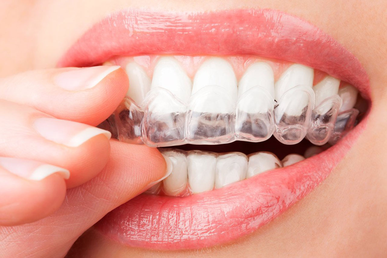 Giá niềng răng trong suốt Quận 3 mới nhất