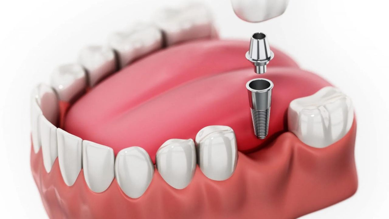 Bảng giá chi phí trồng răng implant Quận 3 - Minh bạch tư vấn chuyên sâu