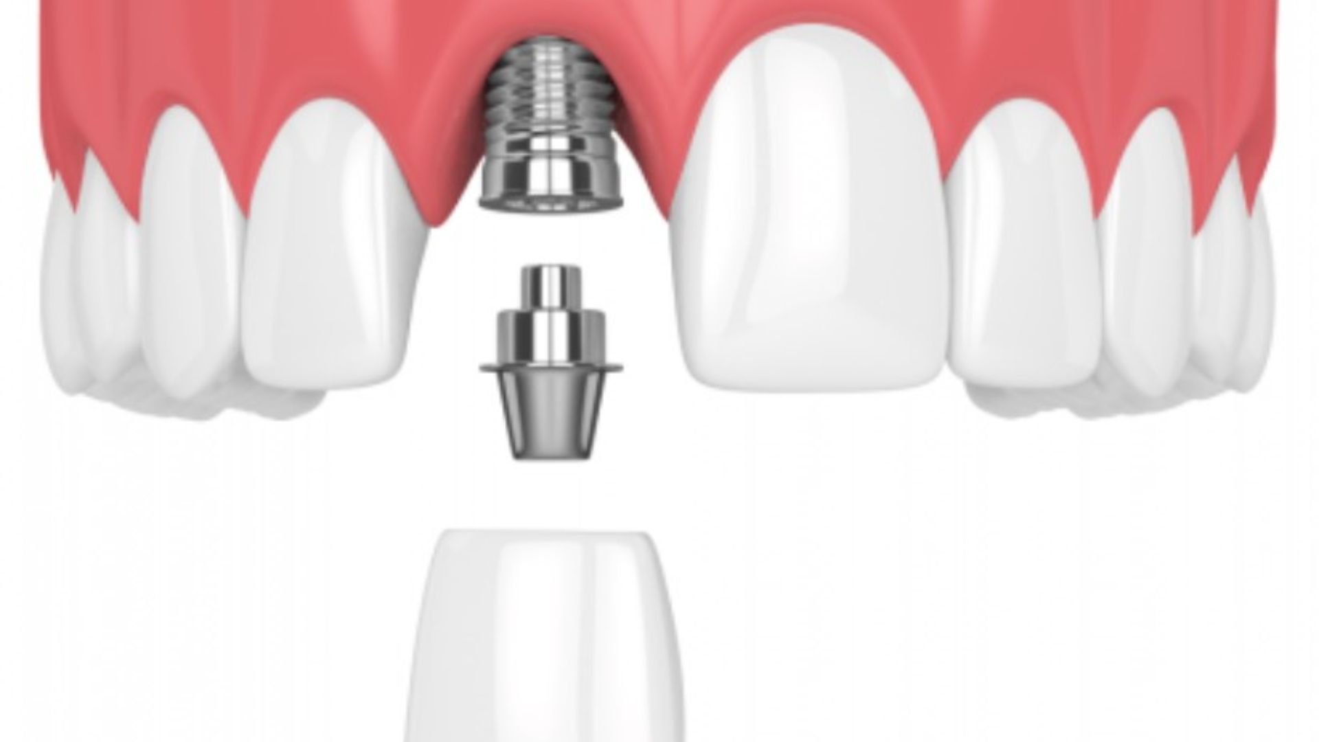 Bảng giá chi phí trồng răng implant Quận 3 - Minh bạch tư vấn chuyên sâu
