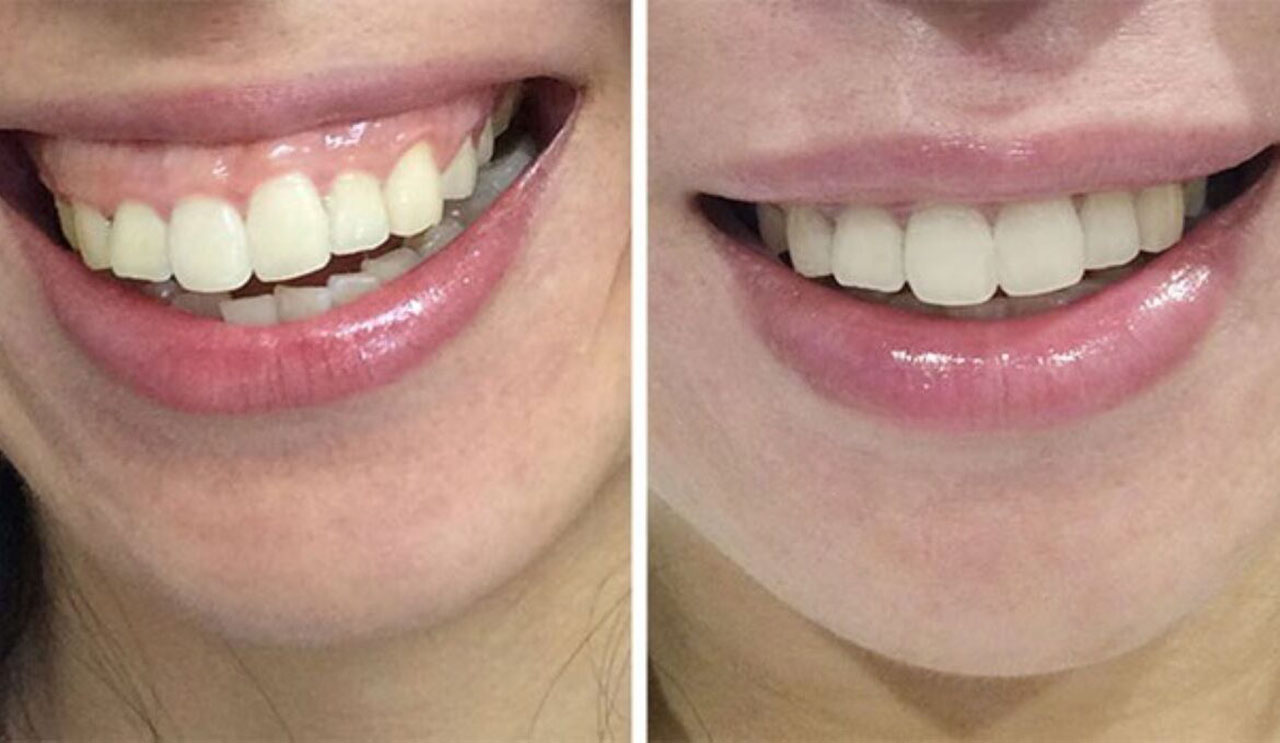 Cắt lợi có ảnh hưởng đến răng không? Bao lâu thì lành và có mọc lại không?