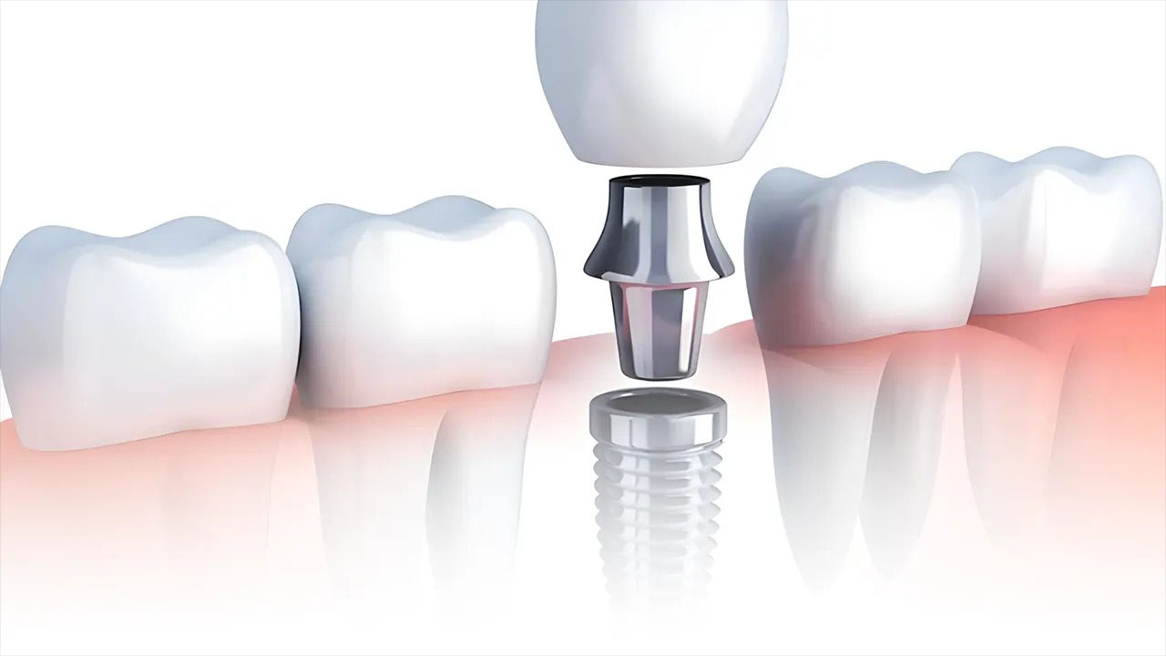 Địa chỉ nha khoa cấy ghép implant uy tín Quận 3