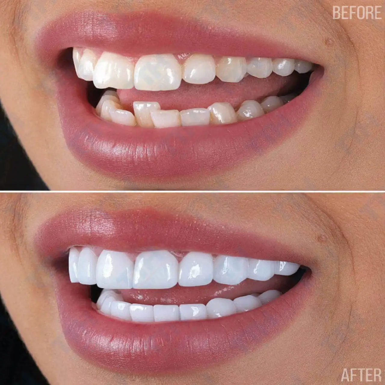 Bọc răng sứ zirconia trả góp TPHCM - Giải pháp thẩm mỹ dễ tiếp cận