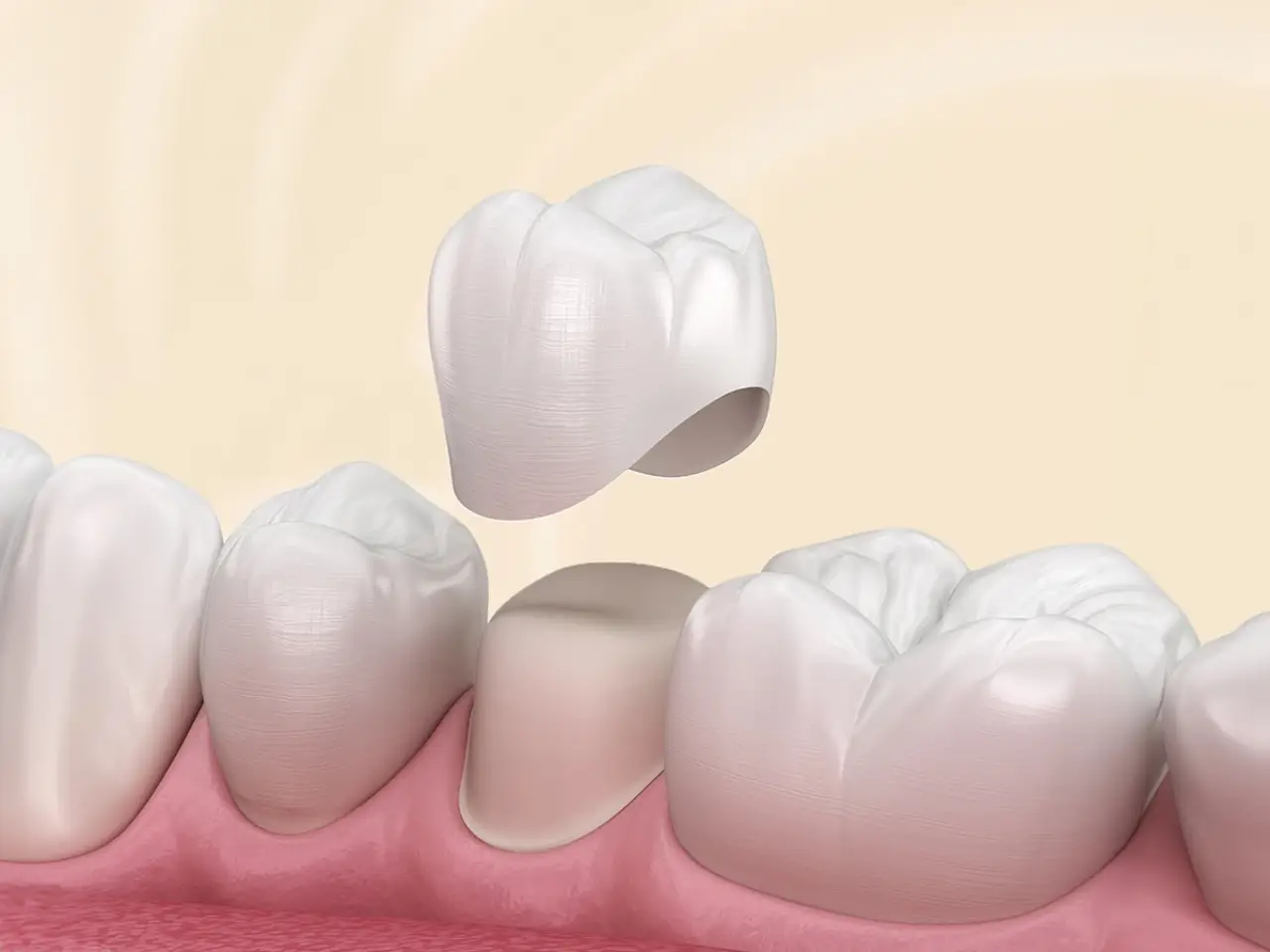 Bọc răng sứ zirconia trả góp TPHCM - Giải pháp thẩm mỹ dễ tiếp cận