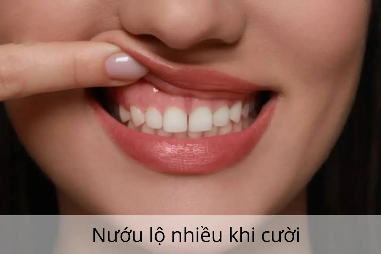 Cười hở lợi là gì? Nguyên nhân và dấu hiệu nhận biết cười hở lợi ở người lớn