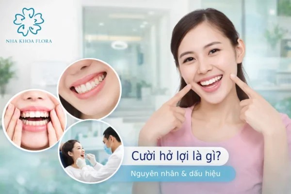 Cười hở lợi là gì? Nguyên nhân và dấu hiệu nhận biết cười hở lợi ở người lớn