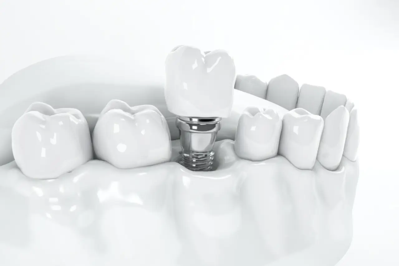 Giá trồng răng implant tại TPHCM bao nhiêu tiền? So sánh chi phí trồng răng implant tại TPHCM