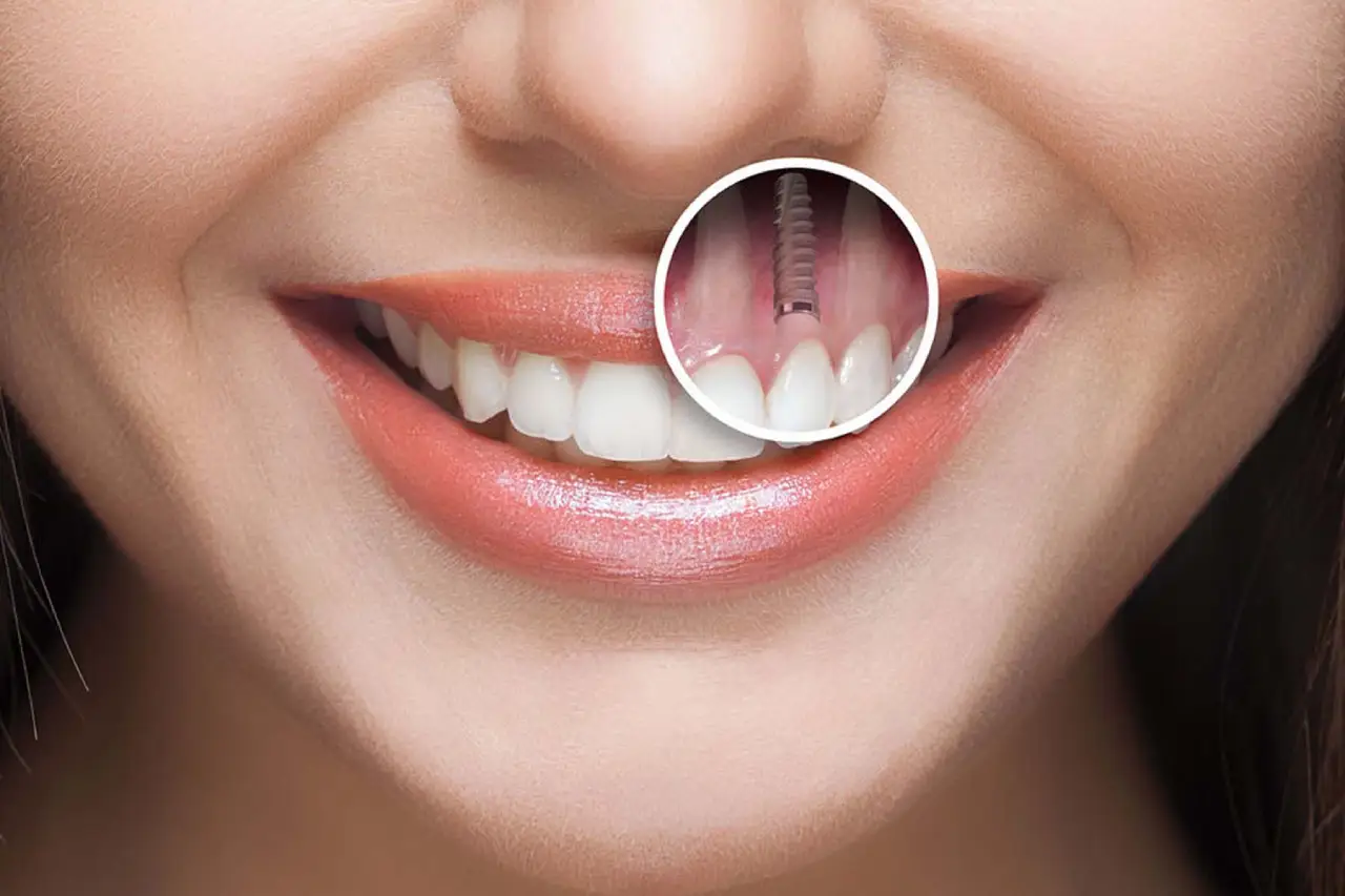 Giá trồng răng implant tại TPHCM bao nhiêu tiền? So sánh chi phí trồng răng implant tại TPHCM