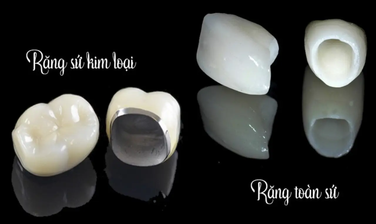 Mài răng bọc sứ có ảnh hưởng không? Phân biệt răng sứ kim loại và toàn sứ