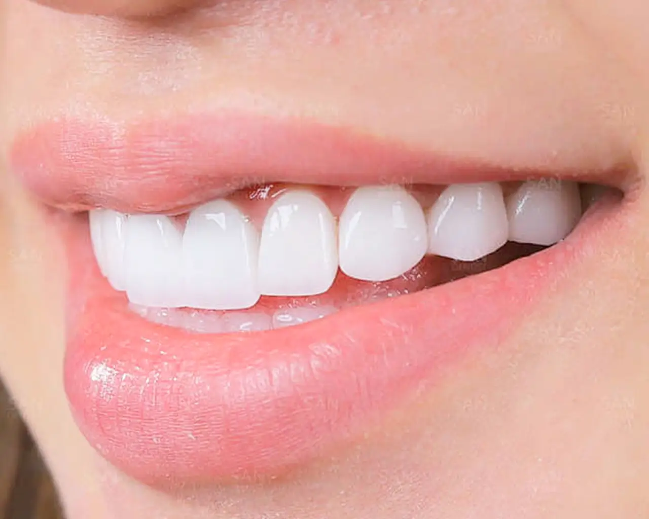 Mài răng bọc sứ có ảnh hưởng không? Phân biệt răng sứ kim loại và toàn sứ