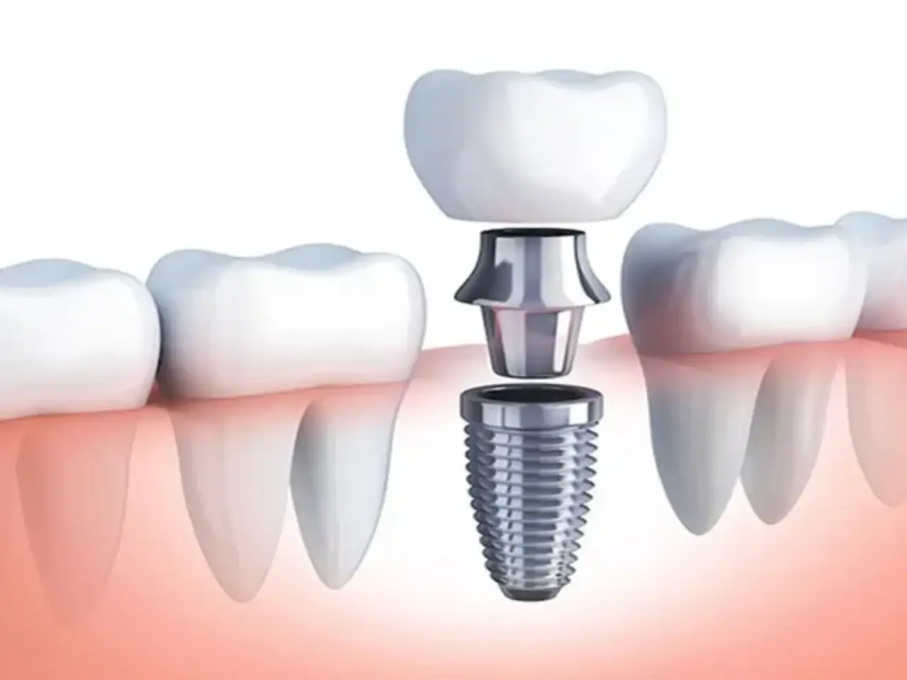 Nha khoa trồng răng implant cho người cao tuổi uy tín giá tốt tại TPHCM