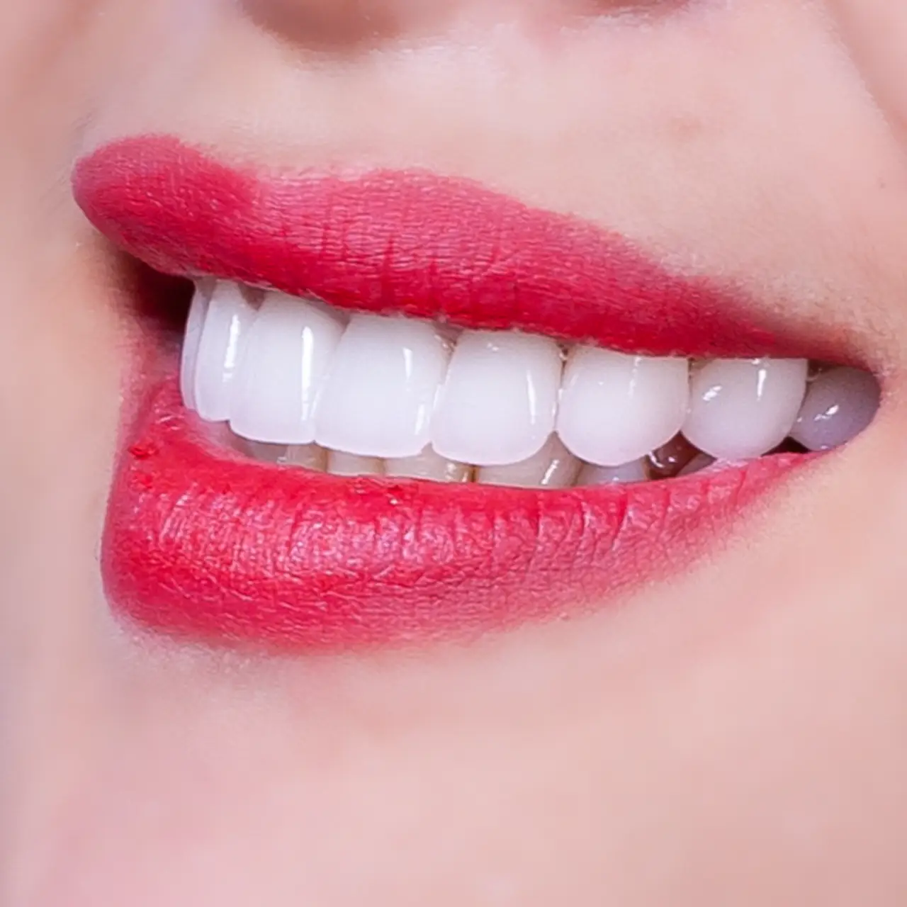 Răng sứ trắng tự nhiên sang trọng - Xu hướng thẩm mỹ hiện đại