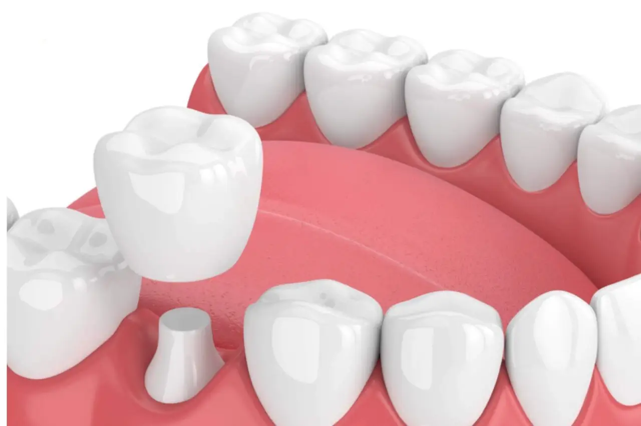 Răng sứ trắng tự nhiên sang trọng - Xu hướng thẩm mỹ hiện đại